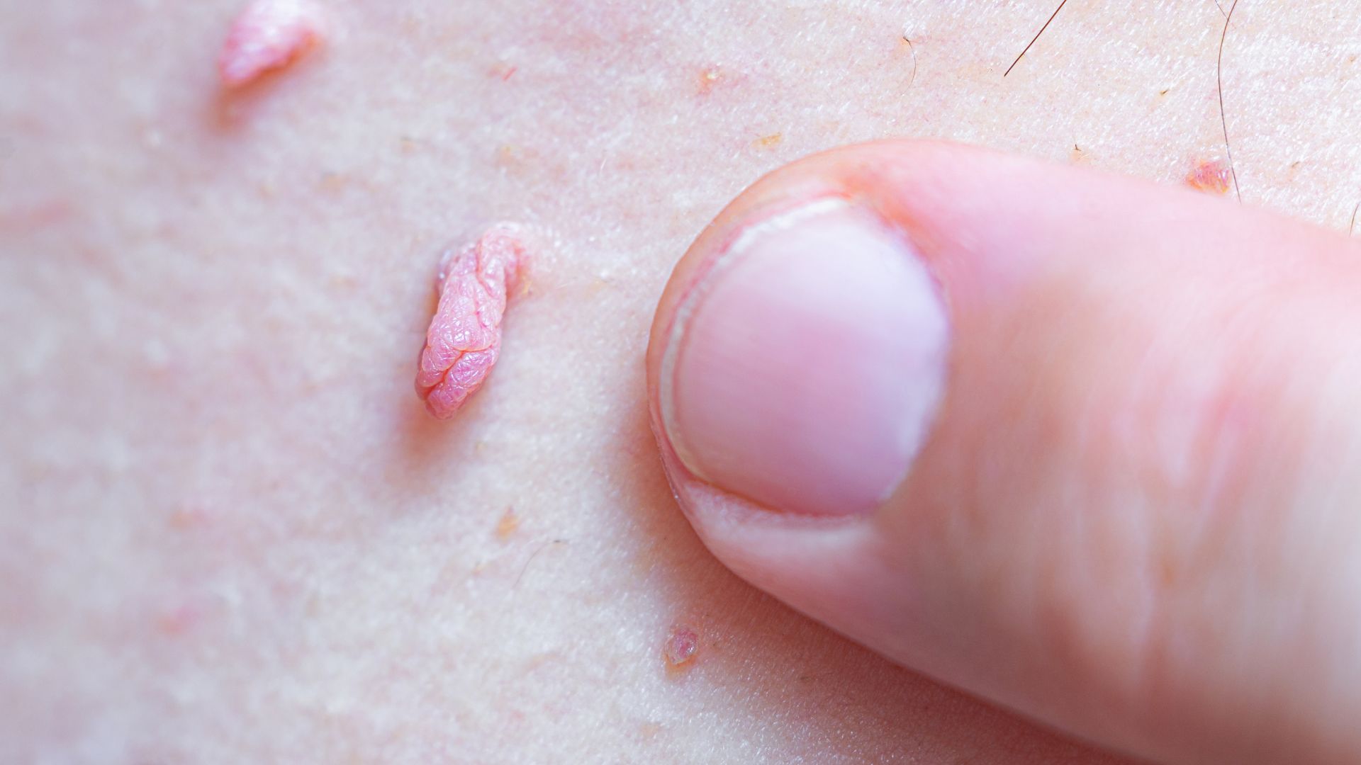 Verrugas genitales por Virus de Papiloma Humano (VPH)
